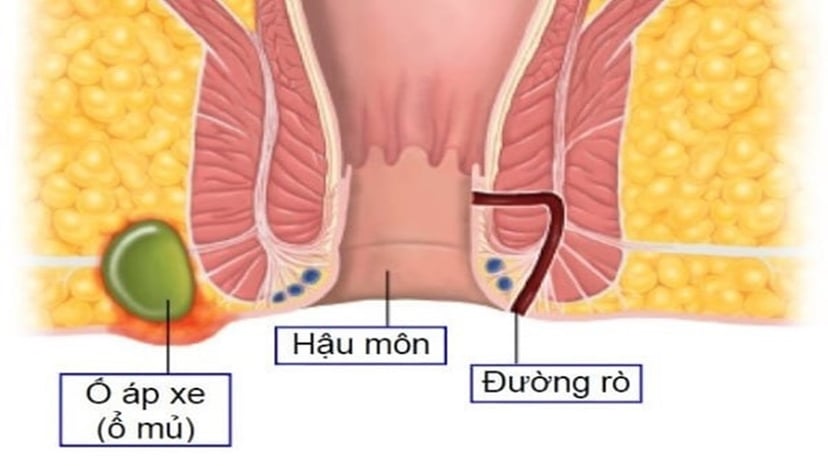 Rò hậu môn và áp xe hậu môn: Phân biệt và điều trị