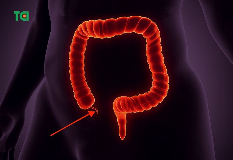 Ruột thừa nằm bên nào trong cơ thể: thông thường ruột thừa nằm ở vị trí bụng dưới, phía bên phải, ngay gần bên xương hông