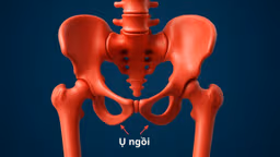 Ụ ngồi: Chức năng, bệnh lý thường gặp và cách điều trị hiệu quả