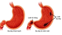 Viêm tá tràng là gì: Nguyên nhân, triệu chứng và các biến chứng