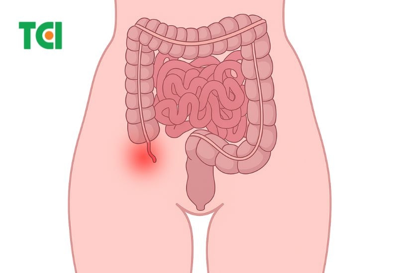Vị trí ruột thừa trong đường tiêu hóa, nằm ở phần hố chậu phải dưới của bụng