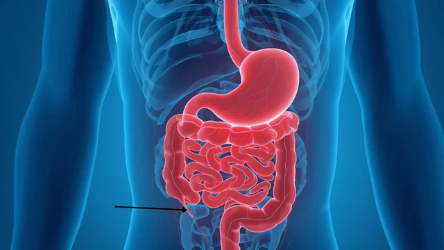 Vỡ ruột thừa là gì: Nguyên nhân và dấu hiệu nhận biết