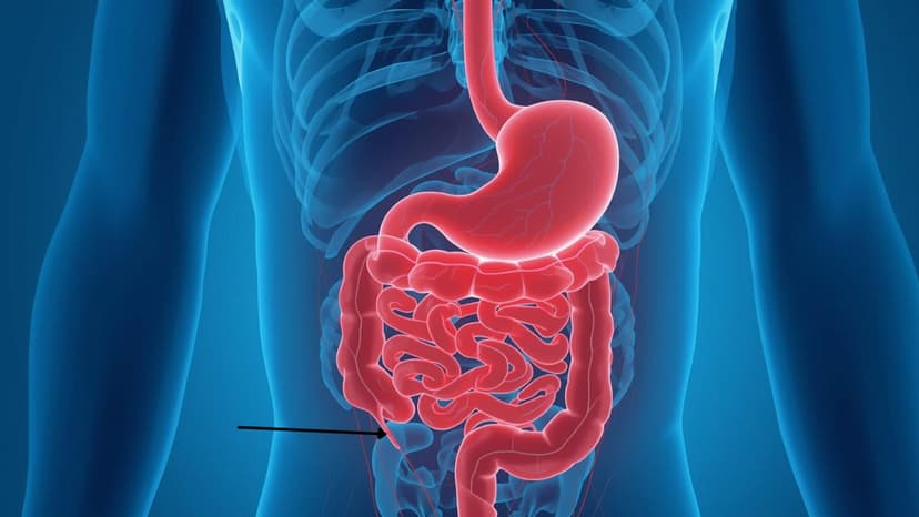 Vỡ ruột thừa là gì: Nguyên nhân và dấu hiệu nhận biết