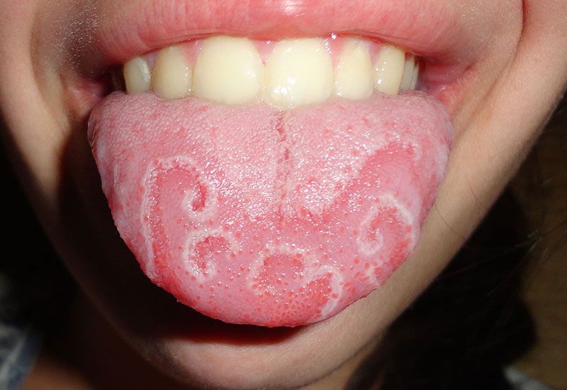 Bị nấm lưỡi là gì