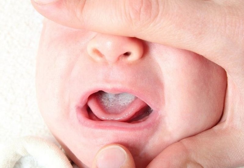 Nguyên nhân dẫn đến tình trạng bị nấm lưỡi