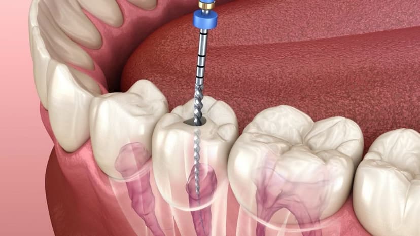Khi nào cần điều trị tuỷ răng? Dấu hiệu nhận biết sớm nhất