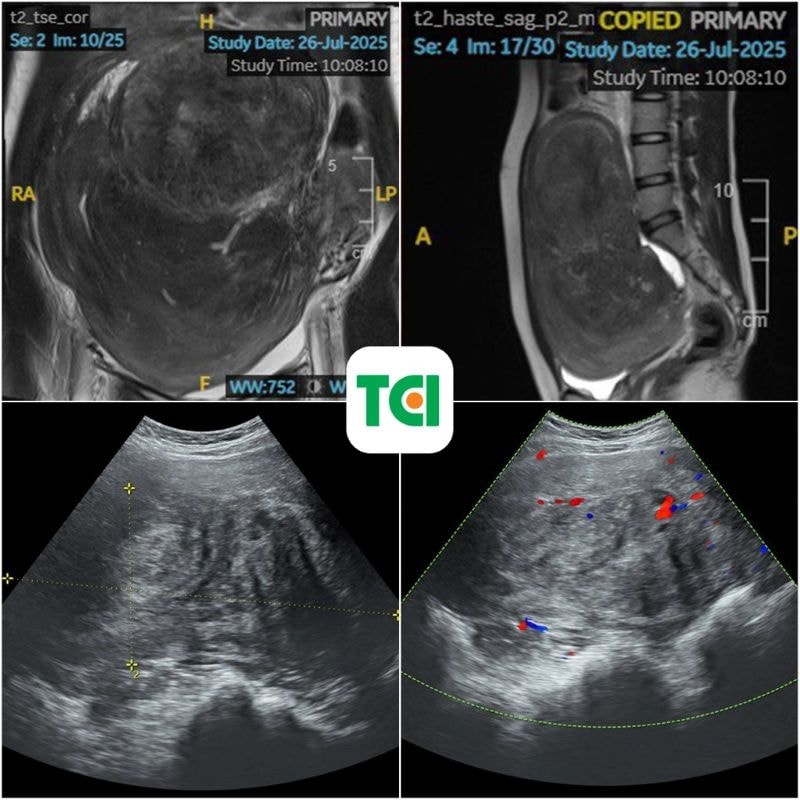 Hình ảnh MRI (phía trên) và siêu âm (phía dưới) cho thấy khối u khổng lồ chiếm toàn bộ ổ bụng.