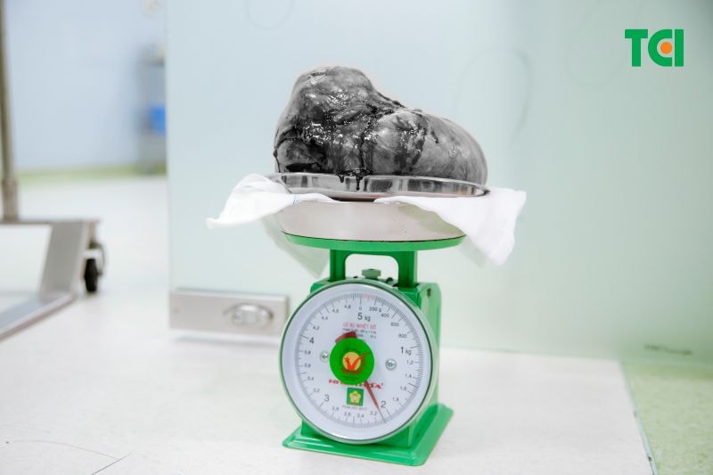 khối u xơ tử cung