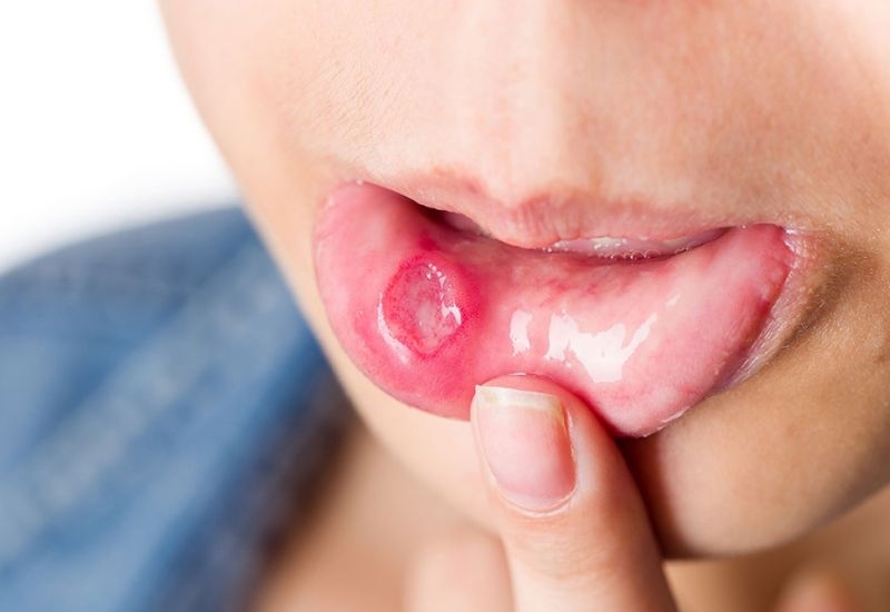 Các yếu tố dẫn đến tổn thương niêm mạc miệng