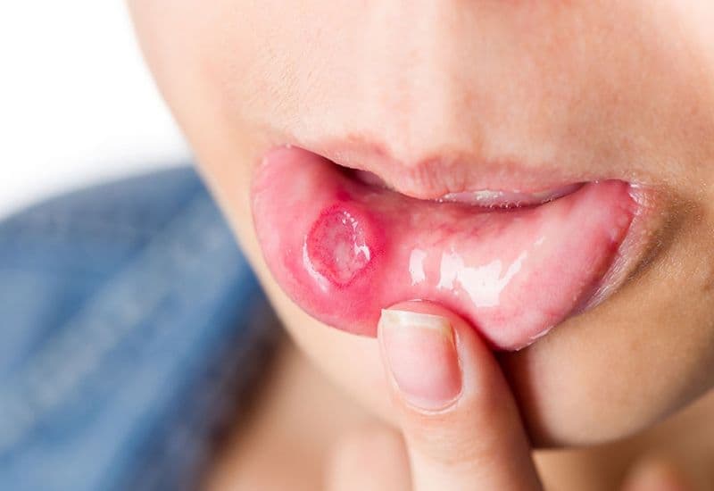 Các yếu tố dẫn đến tổn thương niêm mạc miệng