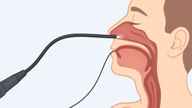 Nội soi dạ dày qua đường mũi: Giảm cảm giác đau, buồn nôn