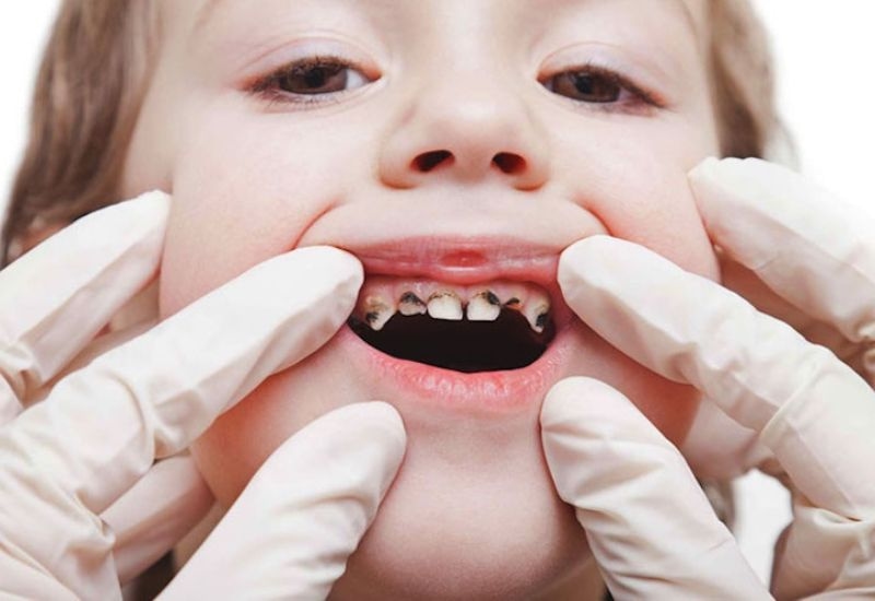 Dấu hiệu nhận biết răng sâu vào tủy