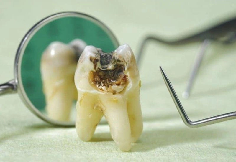 Tác động đến sức khỏe răng miệng khi răng số 7 bị sâu vỡ