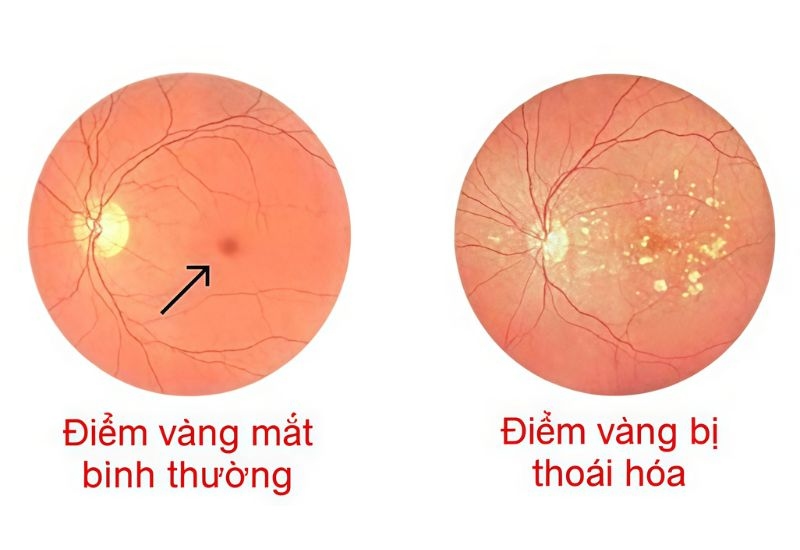Khái niệm về bệnh thoái hóa võng mạc
