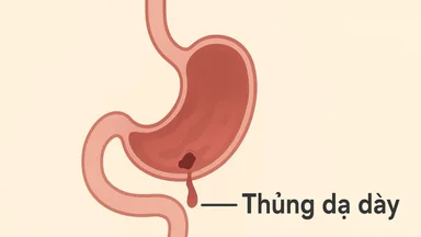 Thủng dạ dày: Triệu chứng nhận biết sớm và những lưu ý