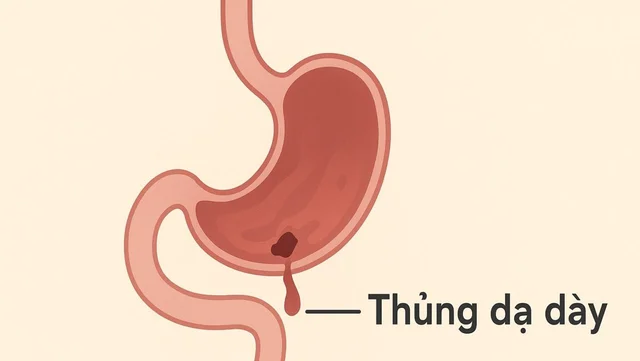 Thủng dạ dày: Triệu chứng nhận biết sớm và những lưu ý