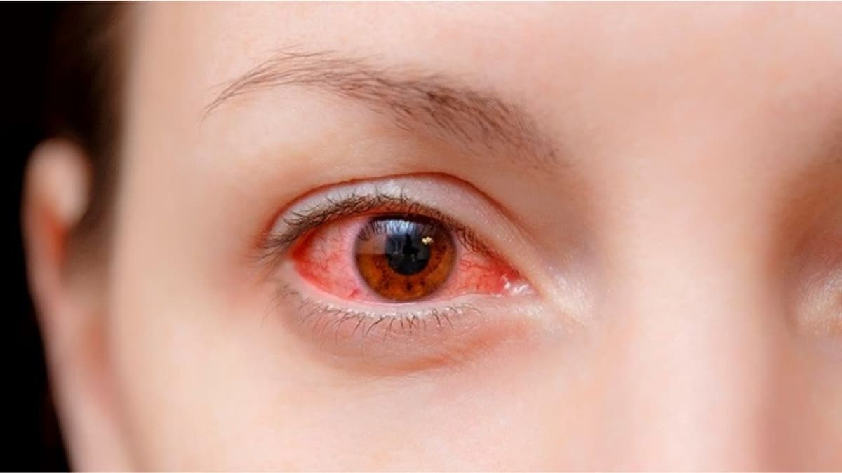Viêm kết mạc cấp: Dấu hiệu nhận biết sớm và cách điều trị