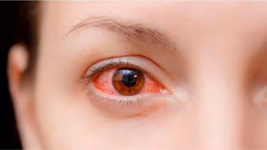 Viêm kết mạc cấp: Dấu hiệu nhận biết sớm và cách điều trị
