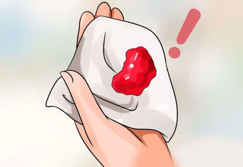 chảy máu đường tiêu hóa trên