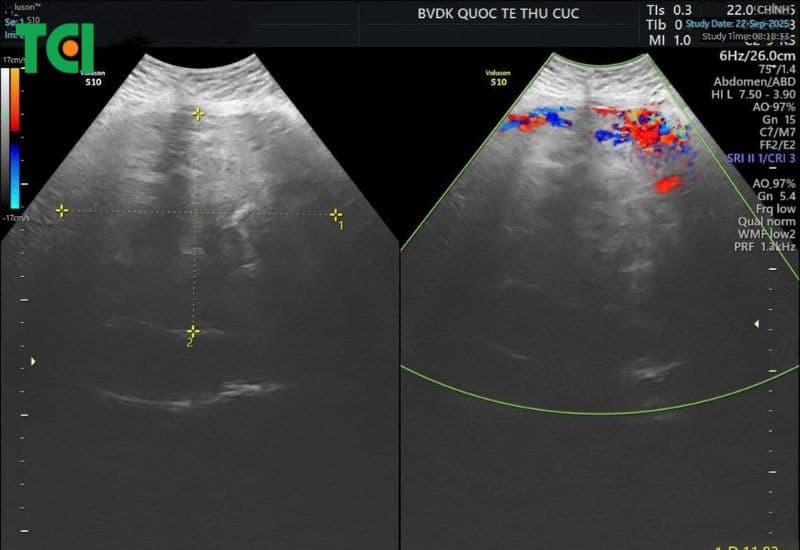 Ảnh siêu âm của người bệnh cho thấy hình ảnh khối u chiếm trọn ổ bụng.