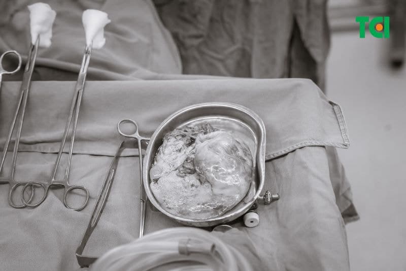 Khối u nang kích thước khủng được loại bỏ hoàn toàn.