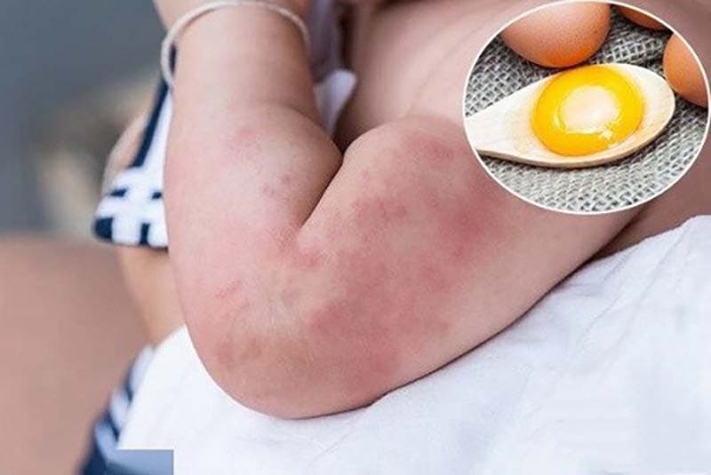 Tay trẻ bị mẩn đỏ do dị ứng, kèm lòng trứng trên muỗng, liên quan nguy cơ dị ứng trứng.
