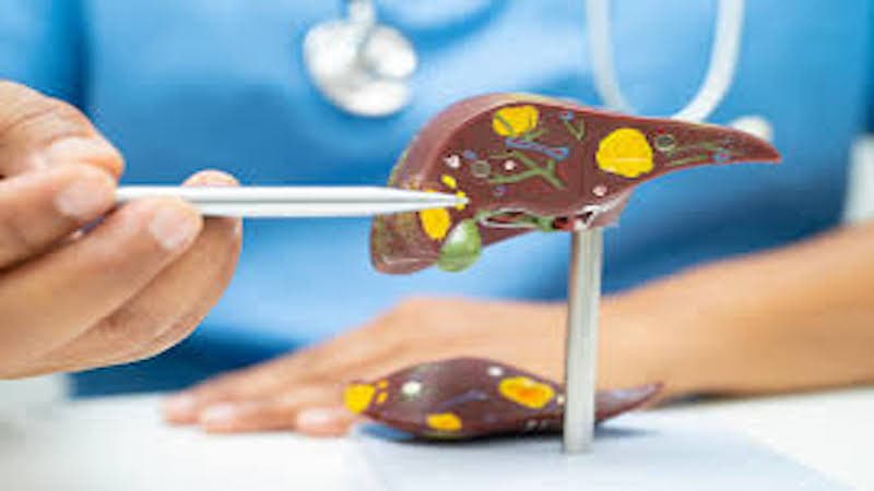 gan nhiễm mỡ độ 4 sống được bao lâu