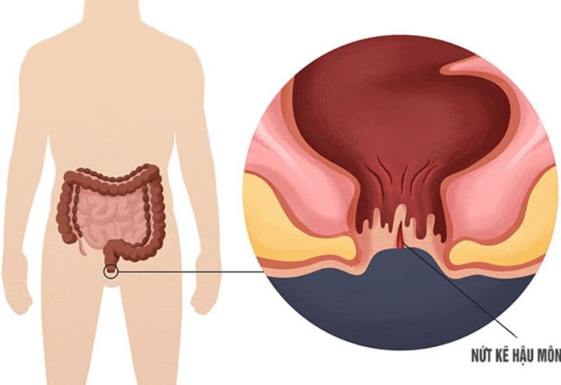 dấu hiệu của bệnh táo bón nặng