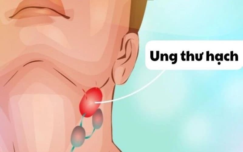 ung thư hạch có nguy hiểm không