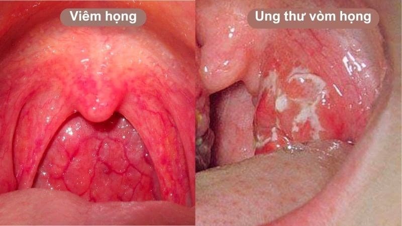 ung thư vòm họng có lây không
