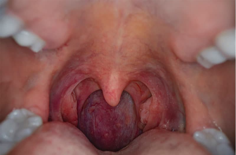 ung thư vòm họng nổi hạch ở đâu