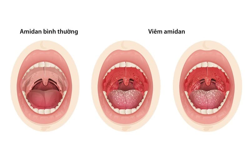 viêm amidan mạn tính có gây ung thư không