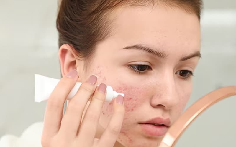bệnh lupus ban đỏ có ngứa không