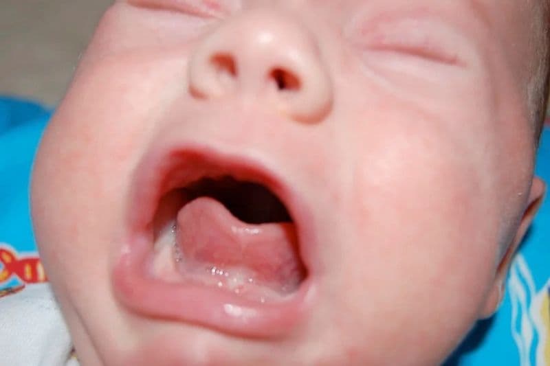 Dính thắng lưỡi phân độ I (Nguồn ảnh: drghaheri.com)