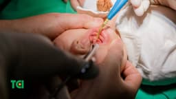 Các cấp độ dính thắng lưỡi, dính độ mấy thì phải cắt?