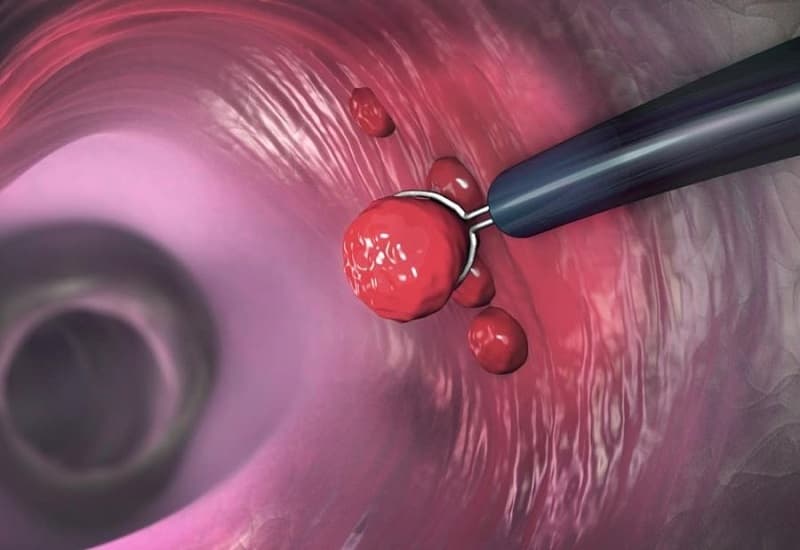 polyp dạ dày có phải là ung thư không?