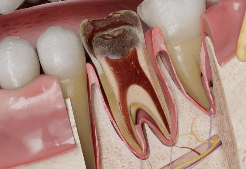 cách giảm đau viêm tủy răng