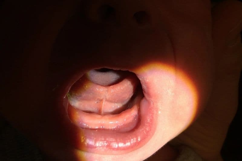 Dính thắng lưỡi mức độ vừa từ 8-11mm (Nguồn ảnh: drghaheri.com)