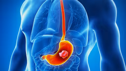 Sau cắt ung thư dạ dày sống được bao lâu?