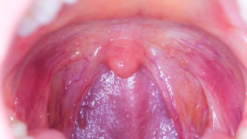 Chảy máu amidan có nguy hiểm không?