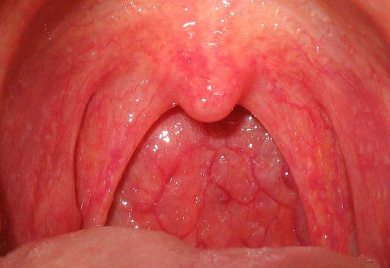 chảy máu sau cắt amidan 10 ngày