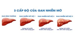 Chỉ số nào cho thấy gan nhiễm mỡ độ 3
