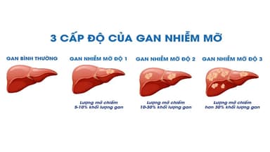 Chỉ số nào cho thấy gan nhiễm mỡ độ 3