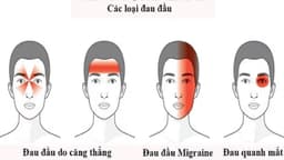 Đau đầu vận mạch điều trị thế nào?