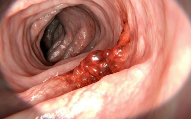 ung thư dạ dày giai đoạn 2