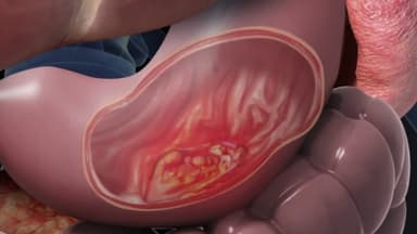 Các dấu hiệu ung thư dạ dày điển hình