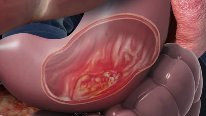 Các dấu hiệu ung thư dạ dày điển hình