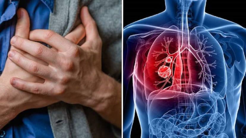 Dấu hiệu ung thư phổi sớm và muộn