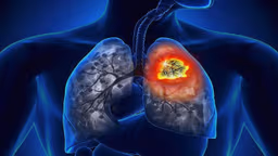 Các dấu hiệu ung thư phổi tái phát sau phẫu thuật