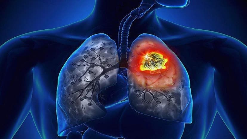 Các dấu hiệu ung thư phổi tái phát sau phẫu thuật